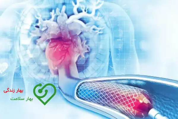 آنژیوپلاستی