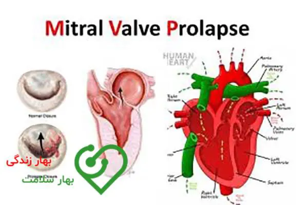 دریچه میترال و افتادگی آن