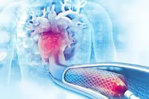 آنژیوپلاستی