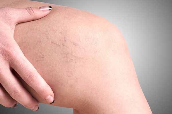 با نشانه‌های اولیه واریس پا آشنا شوید