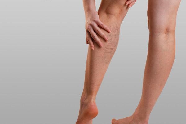 هرچه باید درباره عوارض واریس پا بدانید