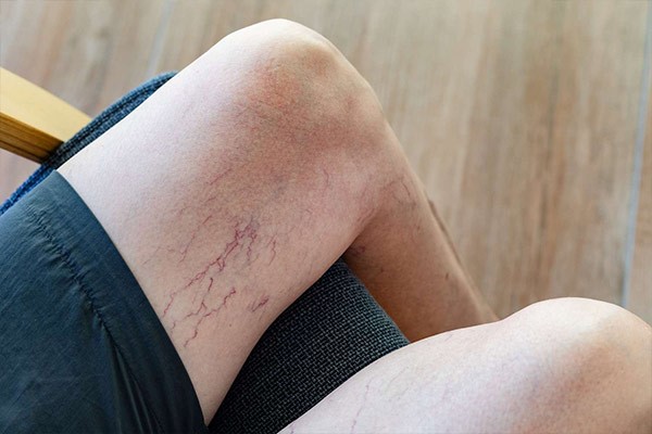 واریس مویرگی چیست و چگونه درمان می شود؟