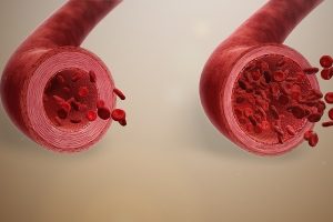 7 علت گشاد شدن رگ های قلب که نمی دانید!