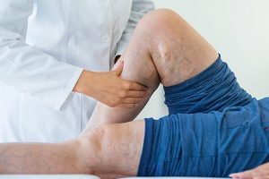 رگ های عنکبوتی چیست و چرا ایجاد می شوند؟