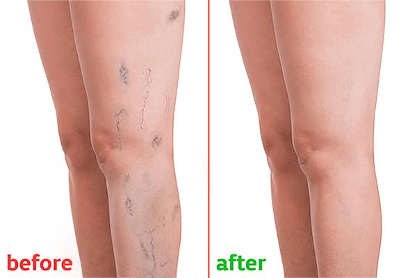 علائم واریس را چگونه تشخیص دهیم؟