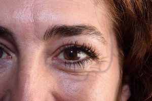 واریس چشم چیست و چه علائمی دارد؟