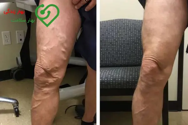 پماد برای درمان واریس: کرم، ژل و اسپری درمان واریس