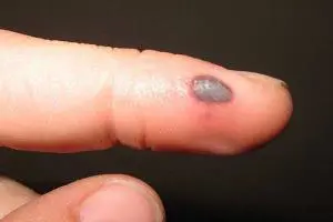 زخم تاول دست