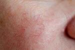 واریس صورت: بررسی علل، علائم و تکنیک های درمانی