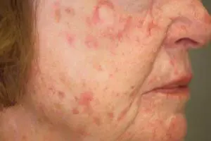 سرطان پوست چیست؟ آشنایی با علائم و نحوه تشخیص