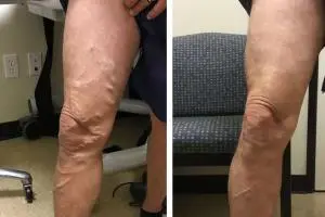 پماد برای درمان واریس: کرم، ژل و اسپری درمان واریس