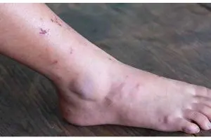 درمان زخم ساق پای دیابتی